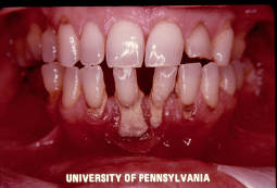 Parodontologia dentisti cassino frosinone